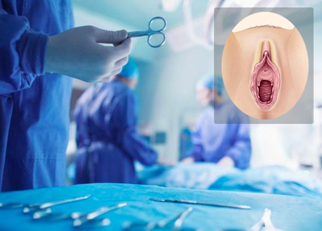 hymenoplasty surgery